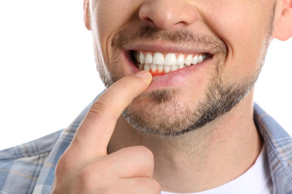 Everything you need to know about Gum disease
